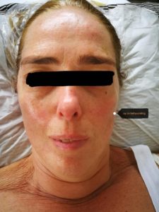 Gezicht na 5x aculift behandeling