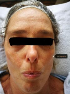 Gezicht voor aculift behandeling