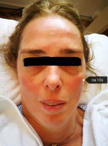 na 10x aculift behandeling